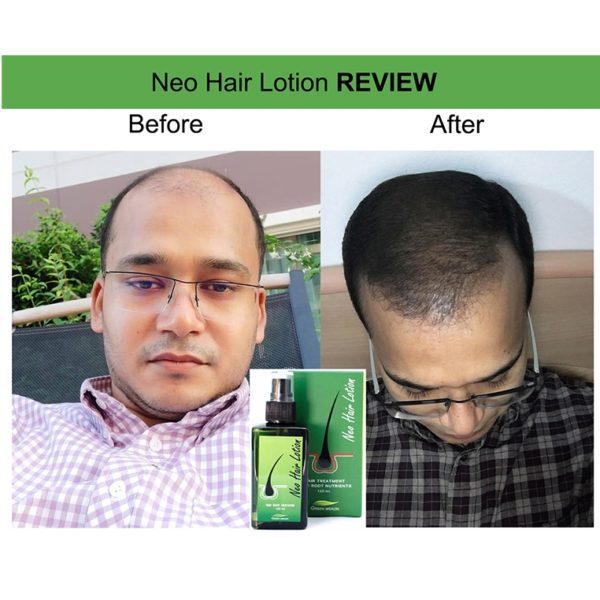 Neo Hair Lotion Hair Root Nutrients Spray 120ml - Geessentials